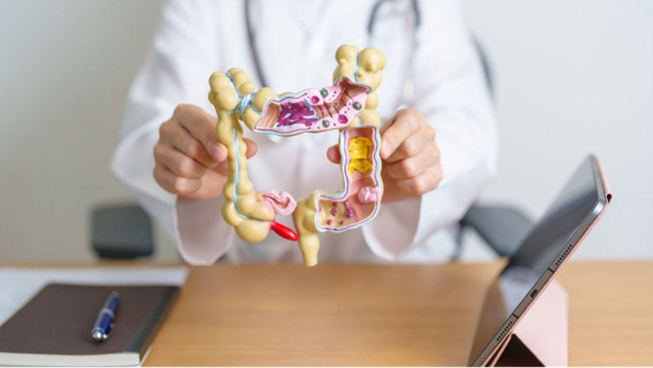 Doctor explaining colon cancer polyps using a colon model during a patient consultation